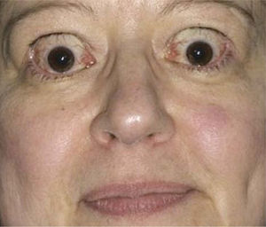 Foto preoperatoria de paciente con exoftalmo y retracción palpebral.