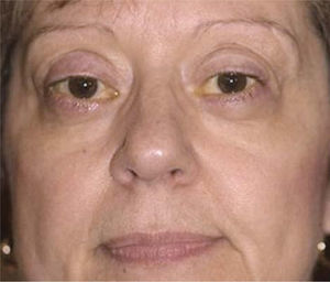 Foto postoperatoria del resultado final de la misma paciente luego de ser sometida a mútiples cirugía reparadoras orbitarias y palpebrales.