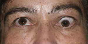 Foto de paciente con signos de actividad de la enfermedad: estrabismo, exoftálmo retracción y edema palpebral superior.