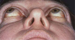 Foto de preoperatoria de paciente con exoftáo severo.