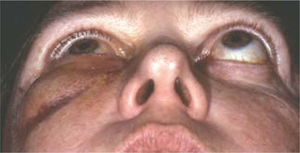 Foto postoperatoria de descompresión orbitaria de 3 paredes.