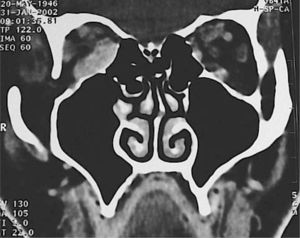 Foto de TAC preoperatorio que muestra gran aumento de volumen de músculos extraoculares, especialmente el recto inferior.