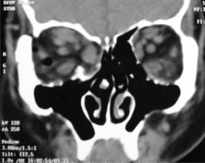 Foto postoperatoria donde se muestra la descompresión de pared medial y piso de órbita derecho.