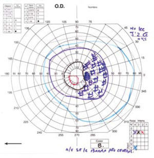 Campimetría de Goldman preoperatoria que muestra disminución severa de campo visual del ojo derecho.