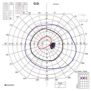 Campimetría de Goldman postoperatoria que muestra un aumento significativo del campo visual del paciente.