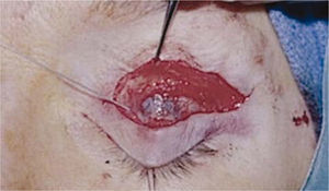 Foto intraoperatoria de reseción del músculo elevador del párpado: se aprecia la desinserción de éste y se trasluce el color del iris a través de la conjuntiva.