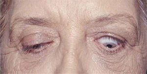 Foto preoperatoria de paciente con retracción palpebral severa del ojo izquierdo.