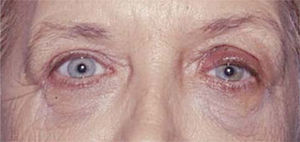 Foto postoperatoria.