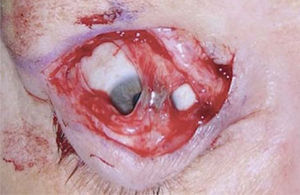 Foto intraoperatoria de técnica de blefarotomía donde se realiza una incisión palpebral de espesor total. Se aprecia puente de conjuntiva para mantener contorno adecuado del párpado.