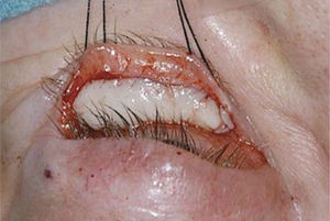 Foto intraoperatoria de cirugía de reparación de retracción palpebral inferior donde se aprecia la sutura de injerto de mucosa de paladar en la cara posterior del párpado.