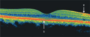 Tomografía de coherencia óptica (OCT) del área macular de un ojo normal. Las zonas más reflectantes tienen colores más cálidos (rojo). En el centro se observa la depresión foveal 1: epitelio pigmentario de la retina, 2: capa de fibras ópticas. En el sector nasal, en dirección a la papila, la capa de fibras ópticas es más gruesa.