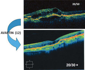 Paciente de 83 años, con pérdida de visión central en su ojo único. El OCT (foto superior) muestra edema de retina (áreas hiporeflectantes) y desprendimiento del epitelio pigmentario. Después de 12 inyecciones de Avastin, la paciente ha recuperado visión útil y del OCT muestra ausencia de edema y recuperación de la depresión foveal.