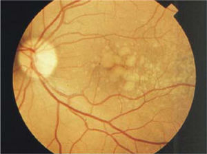 Drusas. Depósitos amarillos de forma redondeada, algunas de tamaño grande, rodeadas de otras de tamaño pequeño.