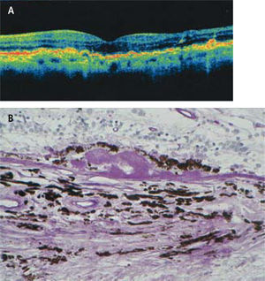 Drusas. A) En el OCT las drusas se aprecian como solevantamientos localizados de la banda del epitelio pigmentario (EP). B) Drusa. Corte histológico muestra acumulación de material amorfo bajo el EP. Tinción de PAS.