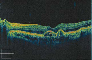 Desprendimiento drusenoide del epitelio pigmentario (OCT). Enormes drusas elevan el EP. La retina tiene morfología normal, pero el riesgo a neovascularización coroidea y pérdida de visión central es alto.