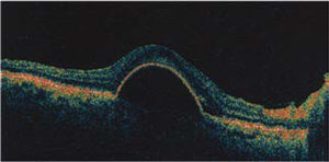 Desprendimiento seroso del epitelio pigmentario (EP) al OCT. Elevación del epitelio pigmentario que se ha desprendido de la membrana de Bruch. Su contenido no es reflectante.