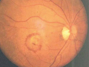 DMRE, forma neovascular. Membrana neovascular coroidea subfoveal. Disco central amarillento enmarcado por un ribete de sangre subretinal.