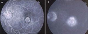 Angiografía retinal con fluoresceína en un caso de membrana neovascular coroidea clásica. La membrana submacular se perfunde con colorante en tiempos precoces del angiograma (A) y muestra abundante filtración en tiempos tardíos (B= filtración).