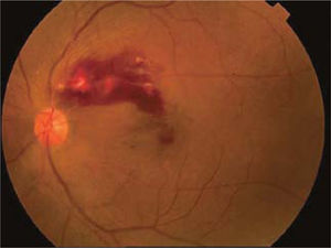 Oclusión de vena de la retina. Se puede observar edema de papila, hemorragias intraretinales en llama, exudados algonosos y edema macular.