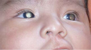 Leucocoria por retinoblastoma Bilateral.