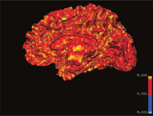 Imagen medial del hemisferio cerebral derecho en la cual ha sido extraída la corteza y se visualiza la superficie de la sustancia blanca. En escala de colores se representa la cantidad de direcciones a este nivel.