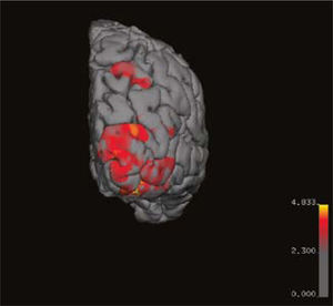 Imagen del polo occipital izquierdo que muestra sobreposición de la actividad de una resonancia funcional visual.