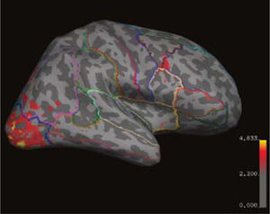 Imagen lateral del hemisferio cerebral derecho “inflada”, con parcelación de los giros (líneas de colores) y sobreposición de la resonancia magnética funcional visual (paleta rojo-naranjo).