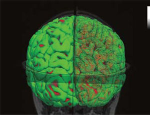Imagen de postproceso que muestra polos occipitales, con mallado del hemisferio derecho (lado derecho de la figura) y superficie “sólida” del hemisferio izquierdo (lado izquierdo de la figura).