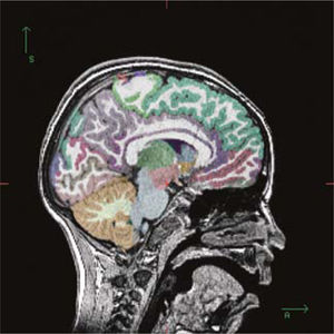 Imagen sagital de segmentación que diferencia las estructuras corticales y el cerebelo utilizando diferentes colores.