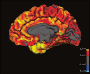 Vista medial del hemisferio cerebral derecho que muestra el espesor de la corteza cerebral en distintas áreas según paleta de color entre 0 y 5mm. Destaca que el lóbulo occipital normalmente es de menor espesor que el resto del cerebro.