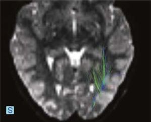 Imagen transversal T2 gradiente que muestra tractos de la vía visual en el polo occipital izquierdo.