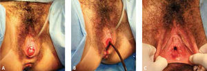Apertura quirúrgica del himen y salida de sangre antigua (a,b). Imagen final de resolución quirúrgica (c).