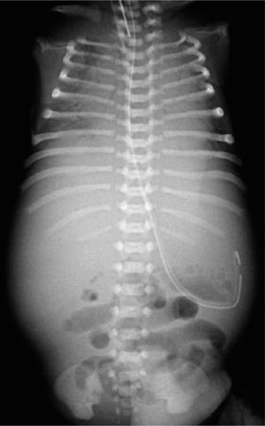 Rx tóracoabdominal evidencia alteraciones pulmonares sugerentes de membrana hialina, hepato-esplenomegalia e ileo.