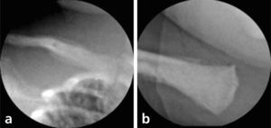 Algunos segmentos óseos visibles en la Rx tóraco-abdominal permiten observar compromiso óseo con marcada periostitis de clavícula (a) y fémur proximal (b).