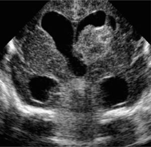 US cerebral transfontanelar muestra HIV grado III, con presencia de gran foco hemorrágico ecogénico a izquierda asociado a dilatación ventricular.