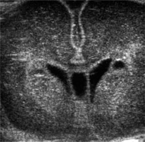 US cerebral inicial, efectuada en los primeros días de vida, evidencia imágenes quísticas periventrículares y aumento de ecogenicidad de ganglios basales.