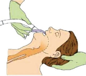 Inserción de mascarilla laríngea.