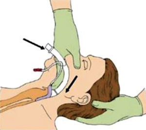 Inserción de mascarilla laríngea