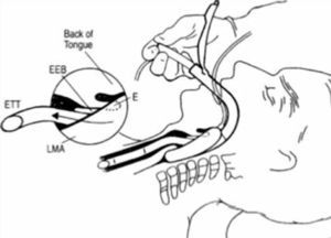 Instalación de Tubo Endobronquial a través de mascarilla laríngea de intubación