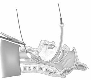Técnica de Intubación retrógrada. Adaptado de Benumof’s Airway Management. Second Edition. 2007 Ed. Mosby