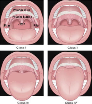 Clasificación de Mallampati.