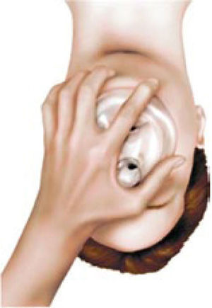 Técnica de Ventilación con mascarilla facial con una mano.