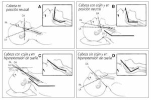 Ejes de la vía aérea y alineación de ellos para la intubación. OA = Eje Oral, PA = Eje Faríngeo LA= Eje Faríngeo.