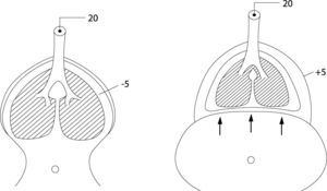 Influencia de la complianza de la pared torácica en la PTP y volumen pulmonar. Cualquier presión de vía aérea dada está asociada con menor PTP en presencia de rigidez de la pared torácica (diagrama derecho) o esfuerzo espiratorio. A la izquierda, la condición normal (Modificado de ref. 5).