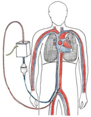 ECMO Veno Arterial: dibujo con configuración habitual que muestra drenaje por vía femoral y reinfusión por vía arterial femoral.
