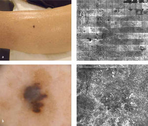(a) Imagen clínica de melanoma maligno, (b) Dermatoscopía, Microscopía confocal panoramica, (c) Microscopia confocal en zona de atipia celular severa.