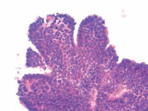 Citología característica de carcinoma papilar.