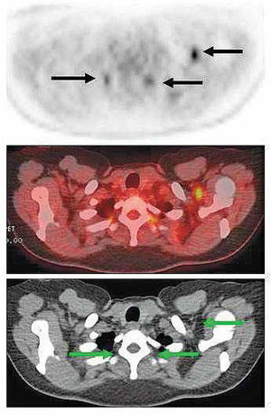 Focos captantes al PET en región supraclavicular izquierda y paravertebral bilateral (flechas) en un paciente con síndrome paraneoplásico. En imágenes de TC y de fusión PET/CT se demuestra la presencia de grasa parda hipermetabólica, sin lesiones neoplásicas en estos cortes.