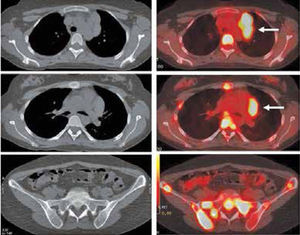 Paciente con Linfoma de Hodgkin en etapificación. En el PET/CT se identifica masa adenopática mediastínica prevascular, hipermetabólica (flechas). Extenso compromiso esquelético a nivel costal, vertebral, esternal y en huesos de la pelvis, sin representación en imágenes de Tomografía Computada (no detectables con TC).