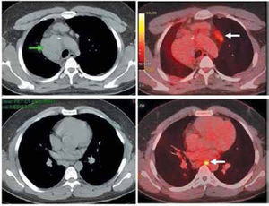 Paciente con linfoma de Hodgkin tratado con quimio y radioterapia (de mediastino) finalizadas hace varios meses. La Tomografia Computada (imágenes a la izquierda) muestra una masa mediastínica alta derecha (flecha verde), sin otras alteraciones. En el PET/CT (imágenes a la derecha) se observa que la masa mediastínica no concentra FDG y es sugerente de corresponder a tejido fibróticoresidual, y que los pequeños ganglios prevasculares y paraesofágico (flechas blancas), no sospechosos según criterios de TC, sí captan significativamente FDG lo que sugiere recaída. Los pequeños ganglios fueron biopsiados con resultado positivo para recidiva del linfoma. La muestra histológica de la masa mediastínica no mostró células neoplásicas.